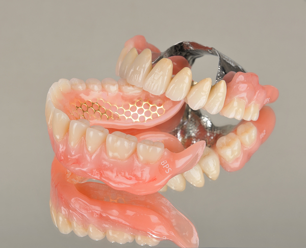 自費診療における金属を用いた入れ歯